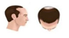 baldness stage type03