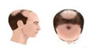 baldness stage type05