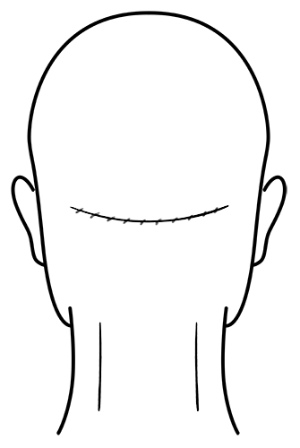 Scalp Micropigmentation