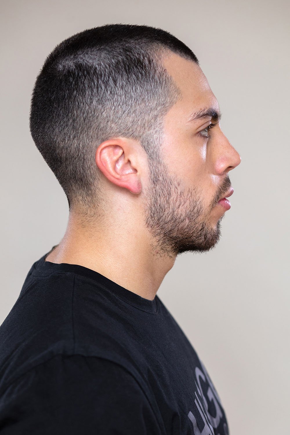 Scalp Micropigmentation