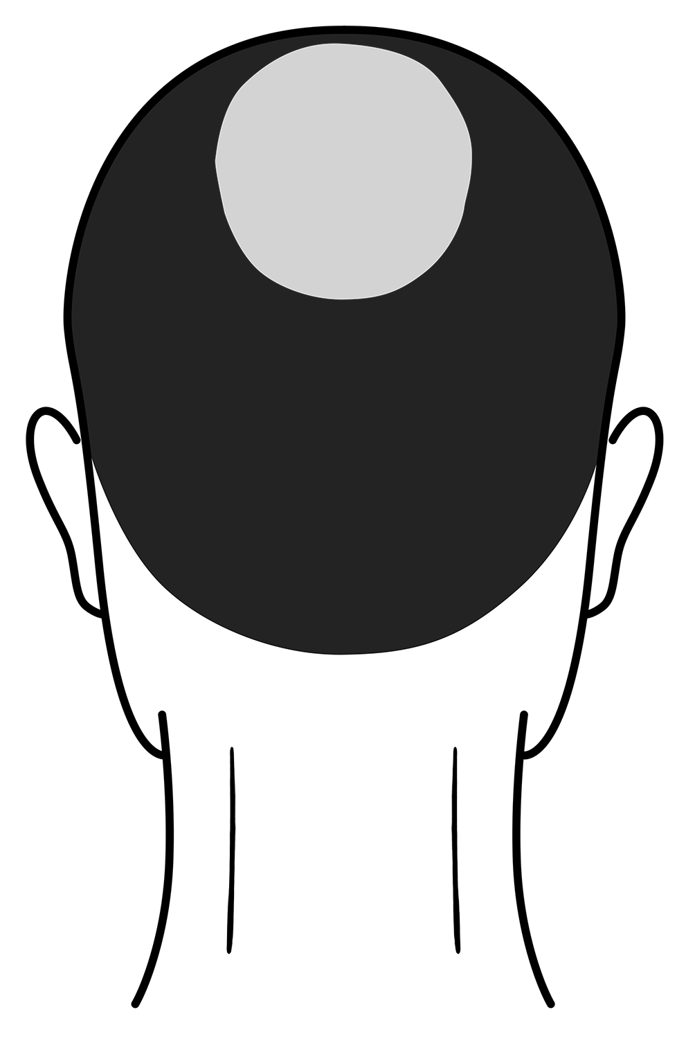 Scalp Micropigmentation