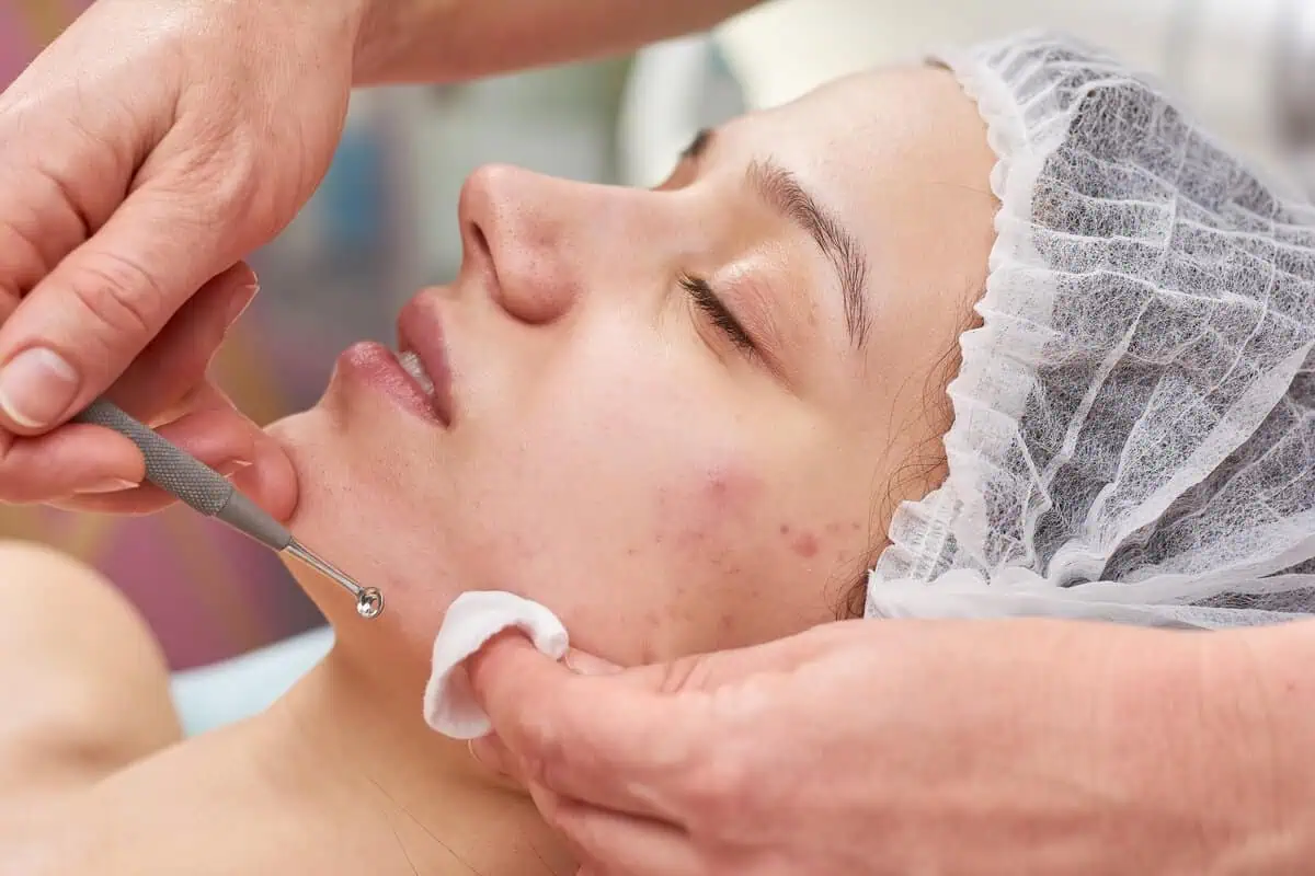 Acne Treatment & Facials in Dubai