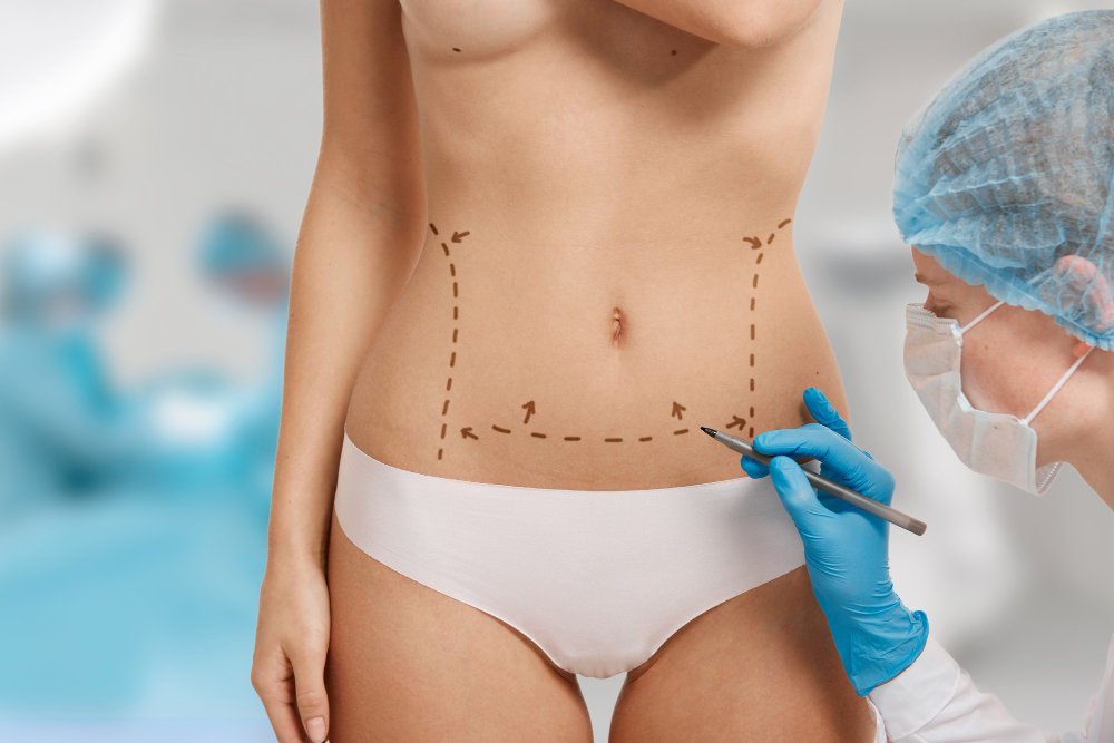 Liposuction treatment in Dubai