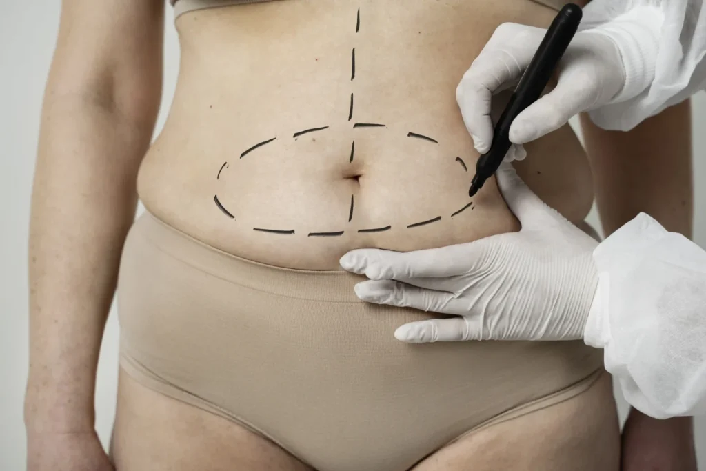 Liposuction treatment in Dubai