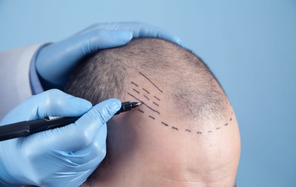 FUE Hair Transplant