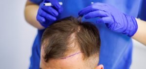 FUE hair transplant