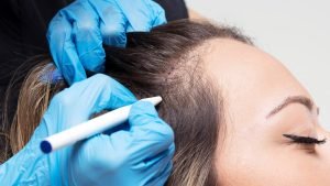 Blog 6 Hair Transplant for Women