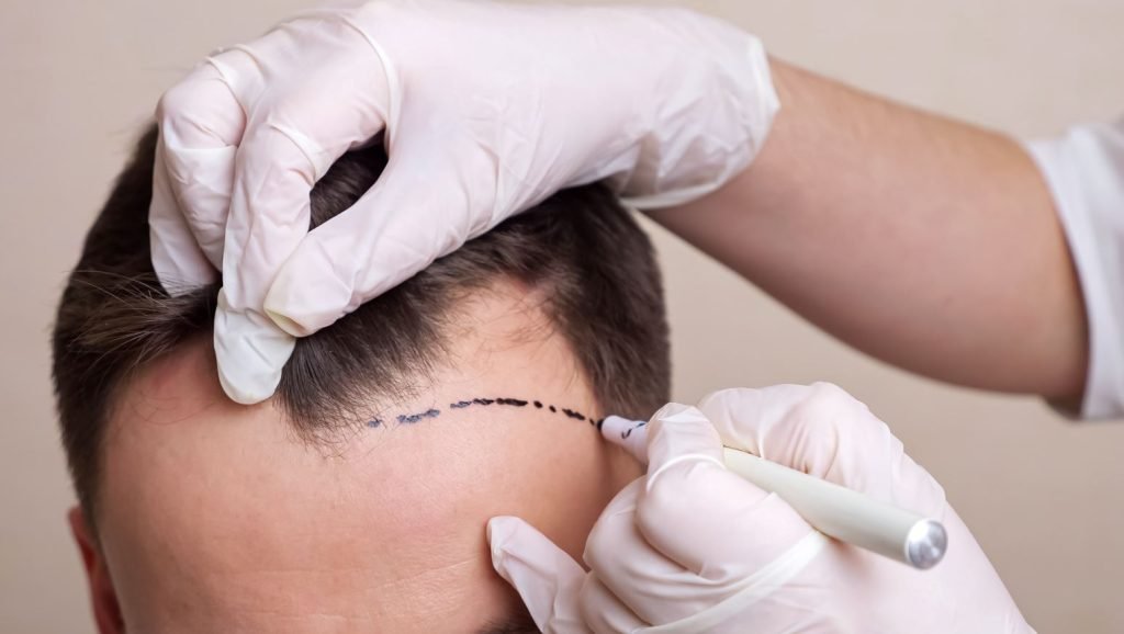 What Factors Influence the Price of Hair Transplant Procedures?