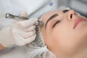 Blog 2 Microdermabrasion