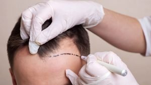 Blog 4 Sapphire FUE Hair Transplant