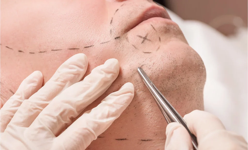 What Is the Recovery Time Like After a Specialized Beard Hair Transplant in Dubai?