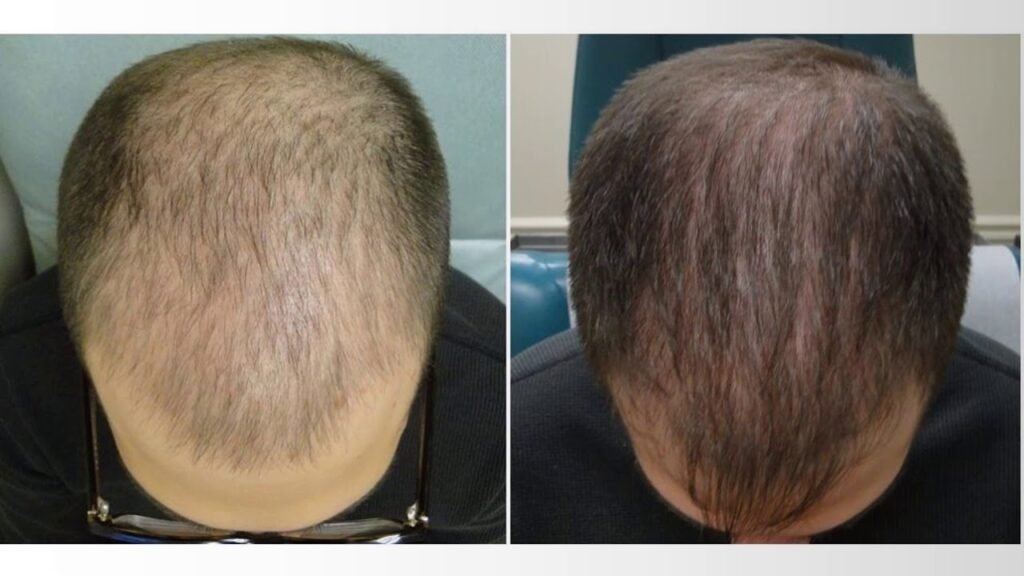 Essential Hair Fall Treatment for Male and Prevention Strategies in Dubai