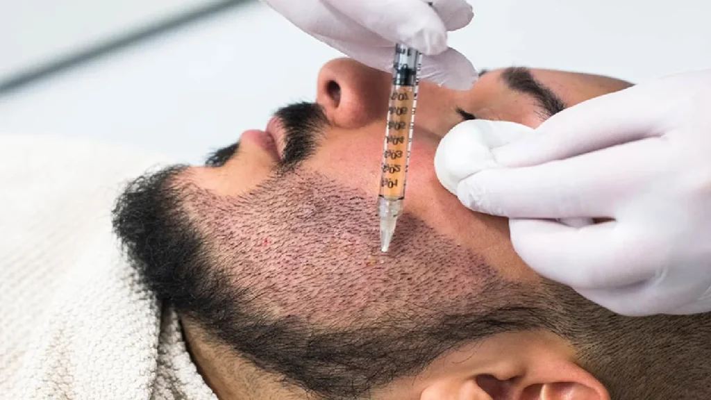 Beyond the Scalp: Precision Beard Hair Transplant Dubai and Eyebrow Design 2 hair transplantation clinic