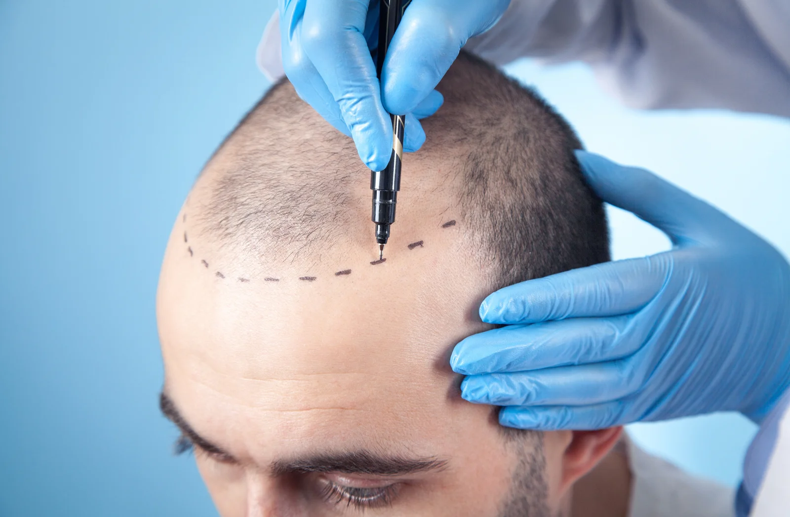 Why Sapphire FUE Hair Transplant Is The New Gold Standard - Hair Transplant  In Dubai By Tunio Hair Transplant