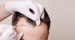 affordable hair transplant