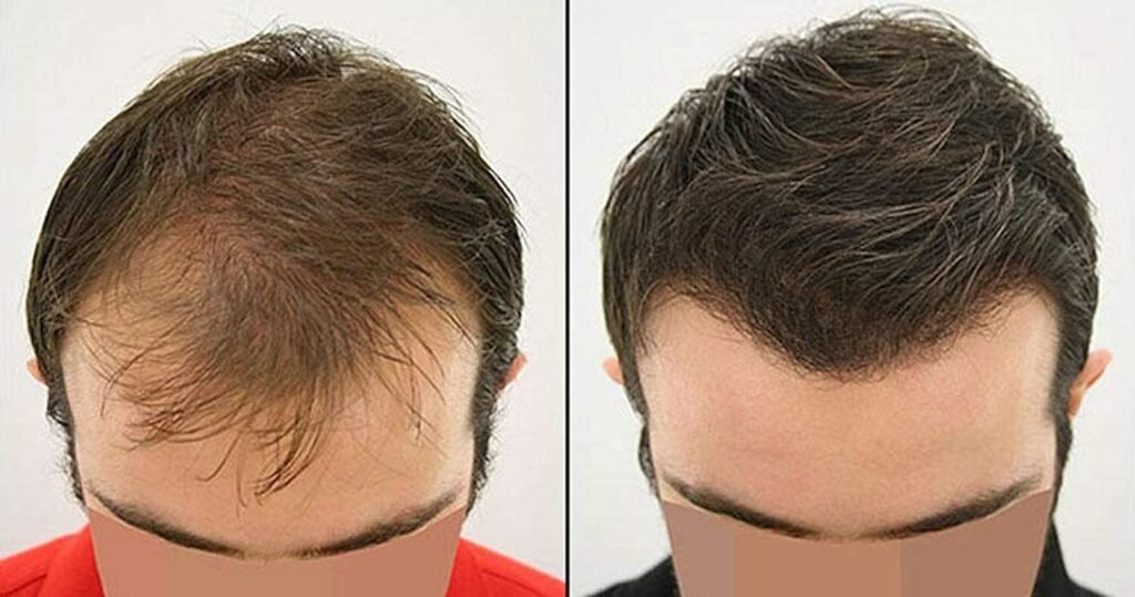 Top 5 “Secret” Tweaks That Make a Hair Transplant Look Expensive 3 Top 5 “Secret” Tweaks That Make a Hair Transplant Look Expensive