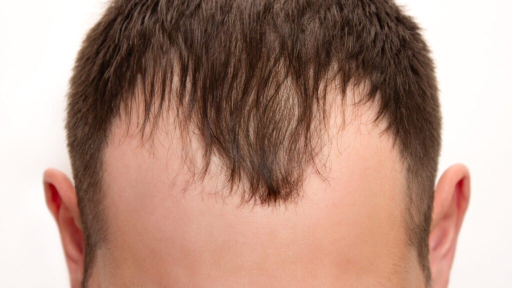 best hair transplant in dubai