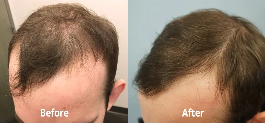 Is Hair Transplant Permanent? What the Results Really Look Like After 5 Years