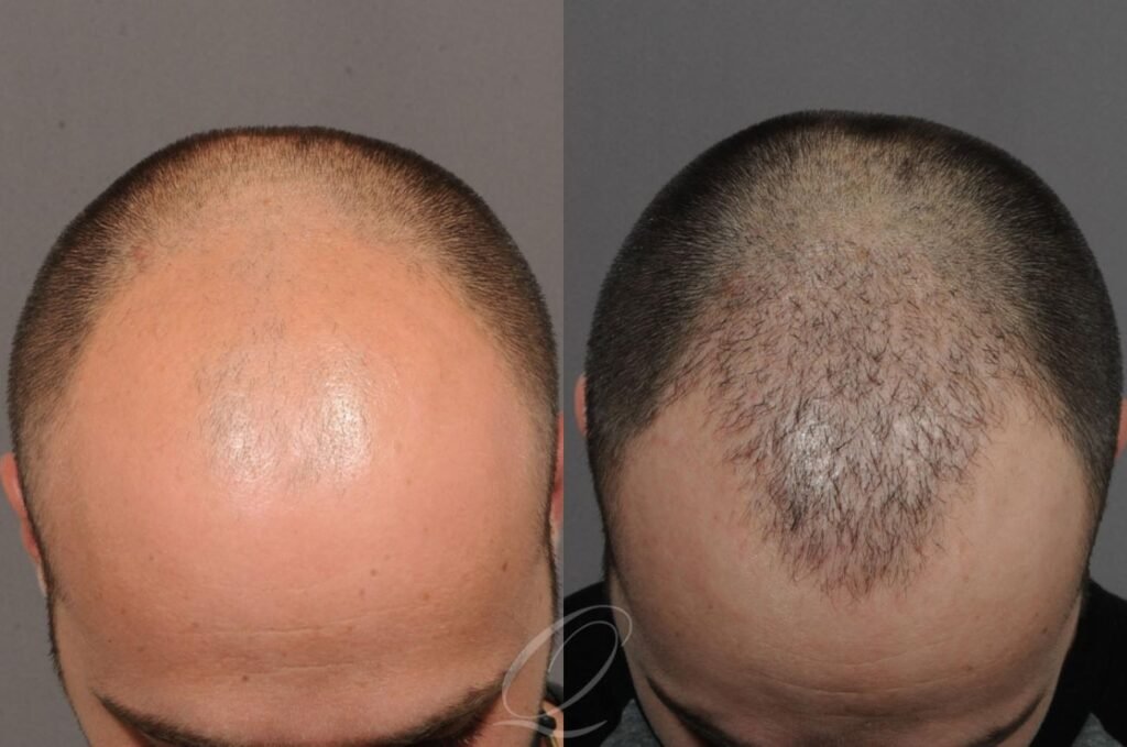 Top 10 Google Questions About Hair Transplants—Answered Honestly 3 Top 10 Google Questions About Hair Transplants—Answered Honestly