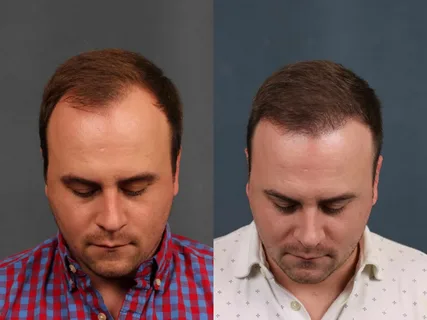 Is Hair Transplant Successful ! 3 Is Hair Transplant Successful !