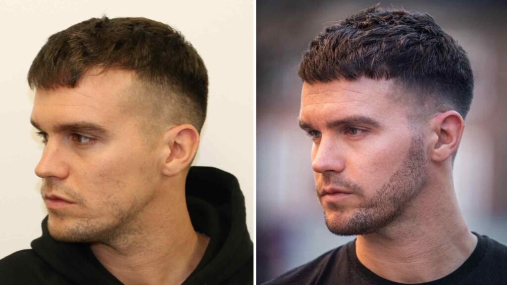 Beard Transplant Cost in Dubai – Expert Insights 3 Beard Transplant Cost in Dubai – Expert Insights